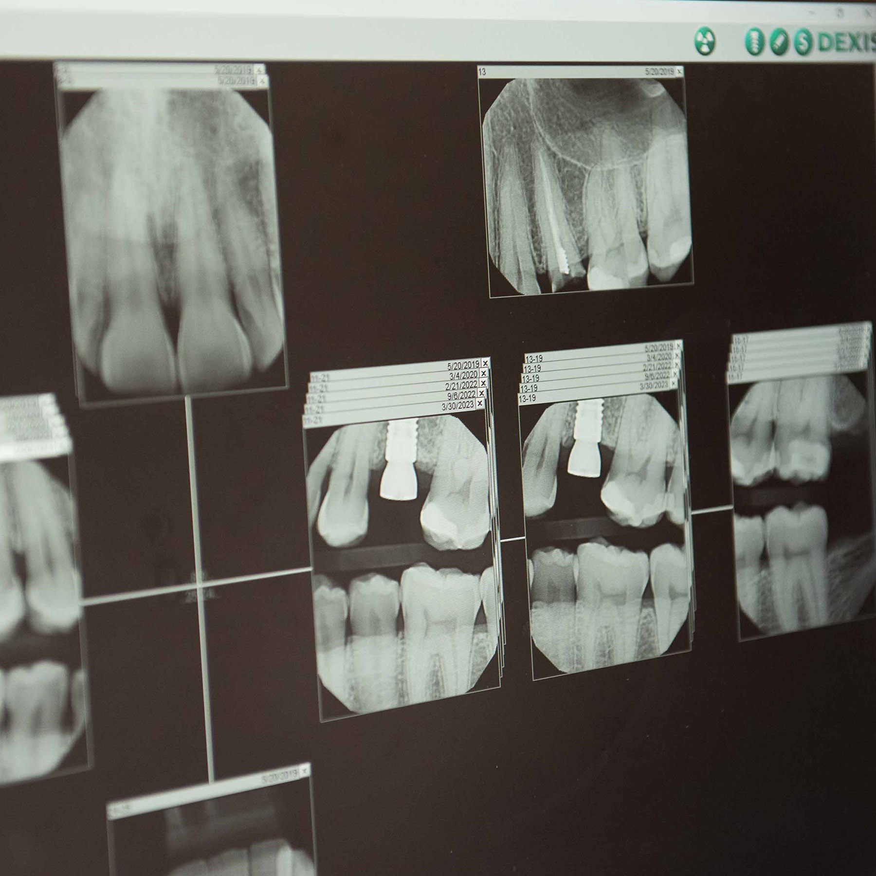 implant_xray_46