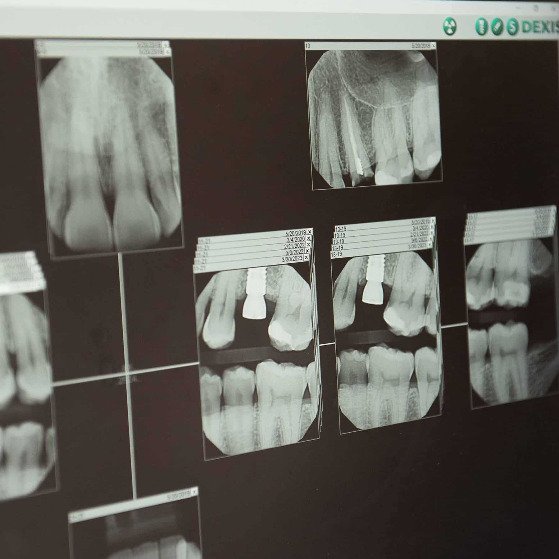 X-rays of dental implants