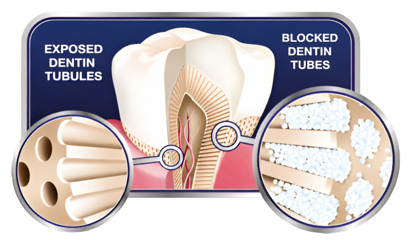 Dentin Tubules Infographic showing open vs blocked dentin tubules